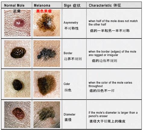 大痦子|点痣不正规可能引发癌变：关于痣的 4 个常识